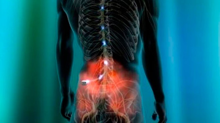 Técnicas mínimamente invasivas qué ofrecemos para el tratamiento del dolor crónico o agudo a nivel de la columna (espalda)