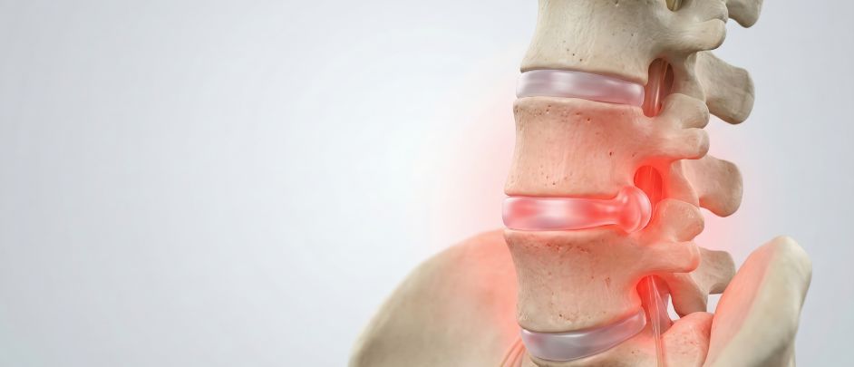 Artrodesis de columna lumbar