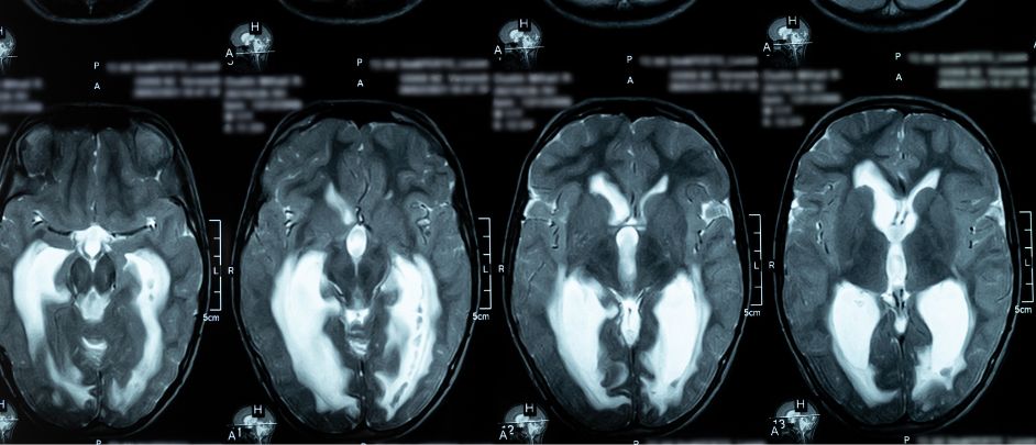 hidrocefalia crónica adultos